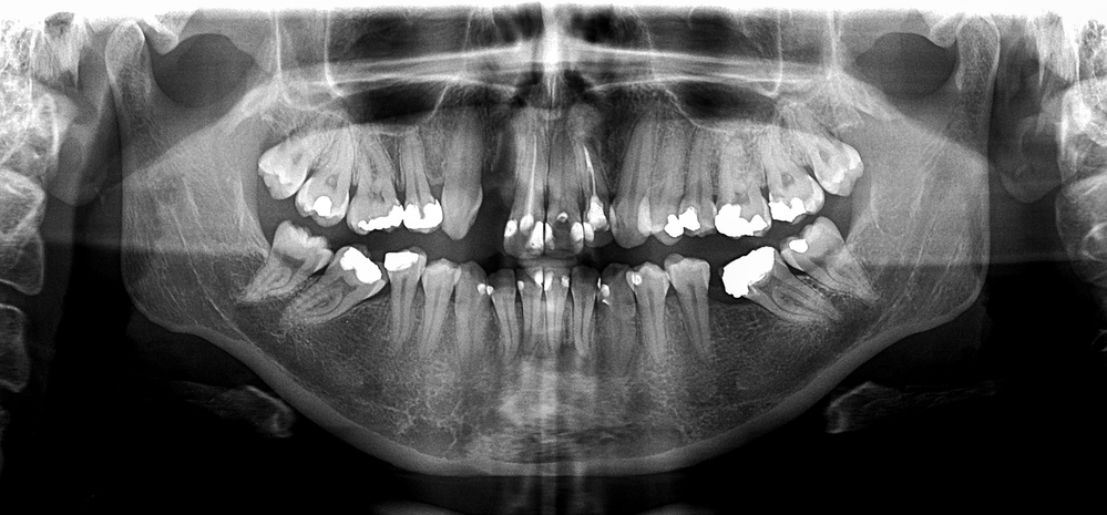 nhs dentist x ray